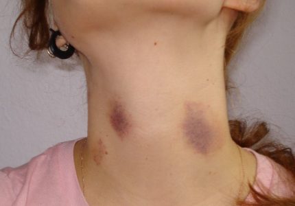 hickeys